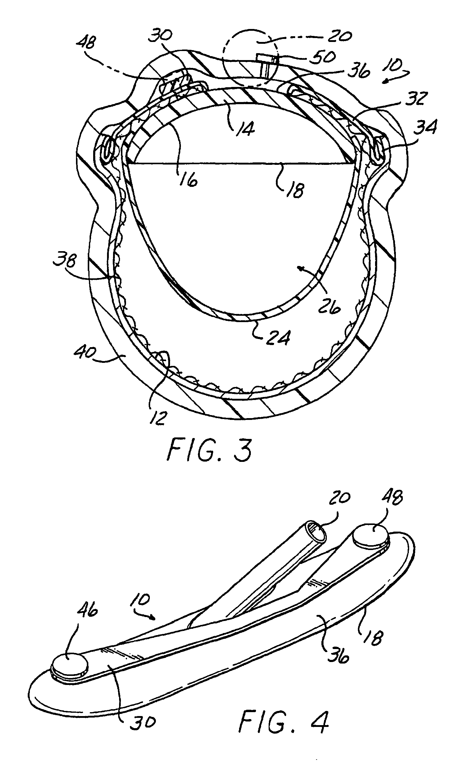 Stable aortic blood pump implant