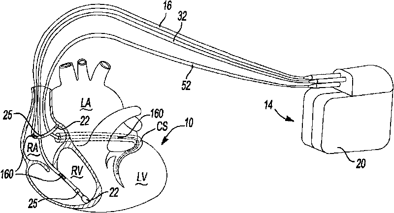 Chronically-implantable active fixation medical electrical leads and related methods for non-fluoroscopic implantation