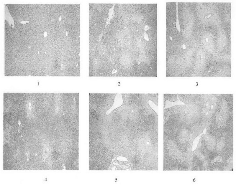 Compound medicine for treating chronic liver disease and preparation method thereof