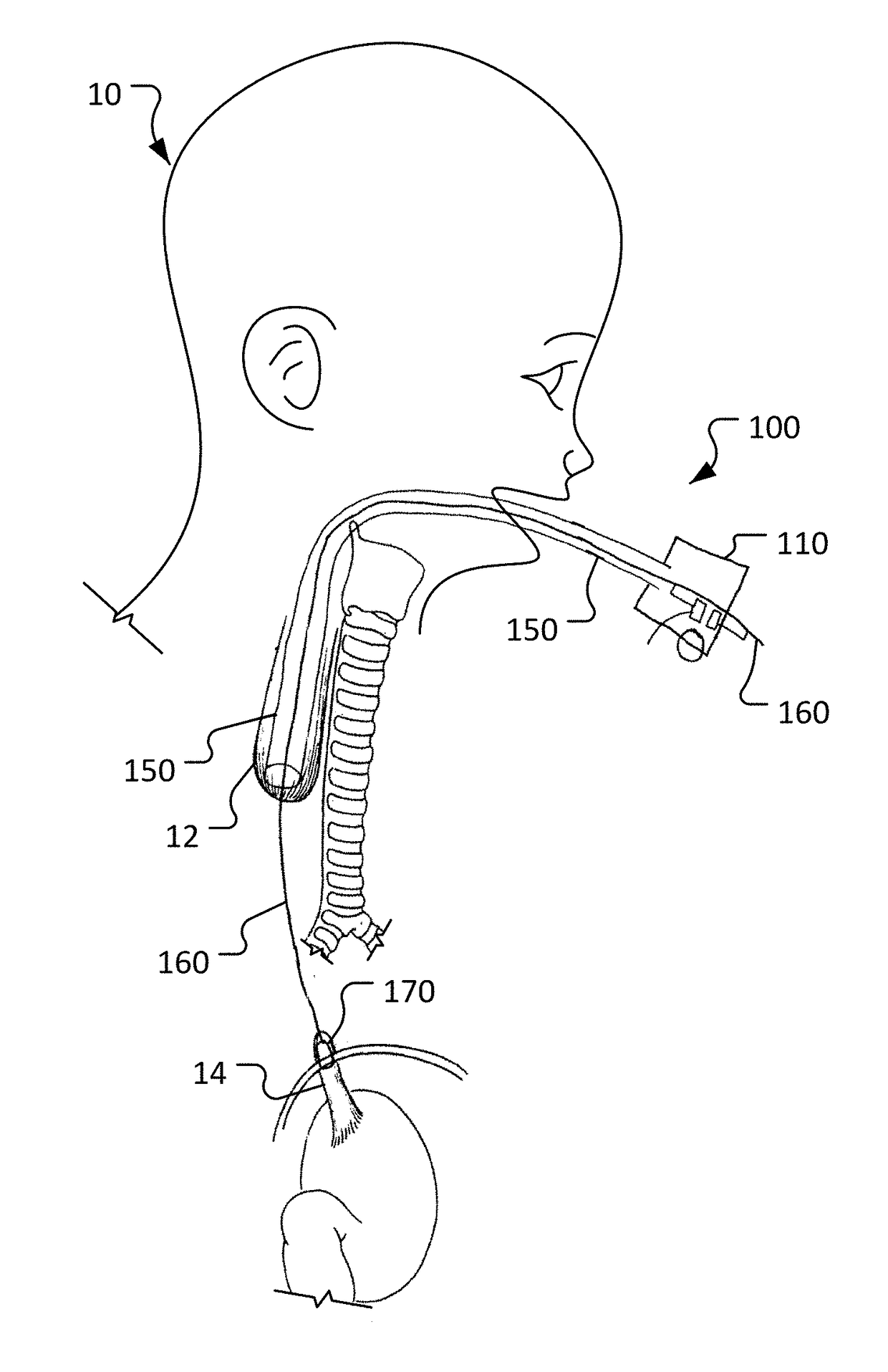 Devices and methods for esophageal lengthening and anastomosis formation