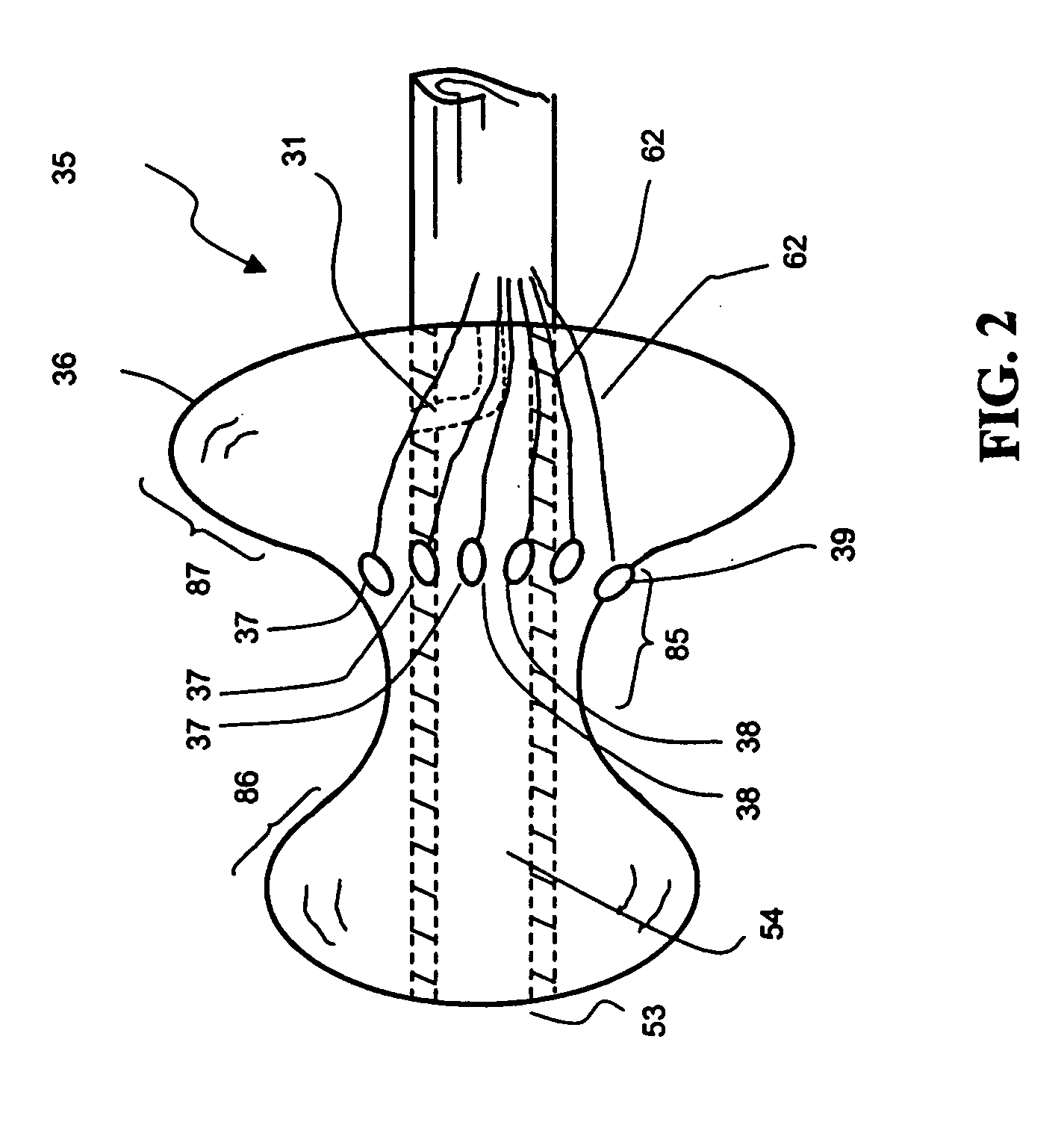 Methods for treating mitral valve annulus with biodegradable compression element