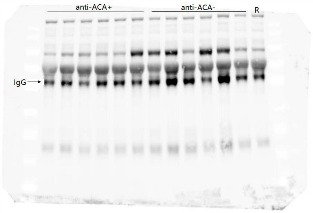 Sugar chain marker for diagnosing PBC patients with positive and negative anti-ACA antibodies and application of sugar chain marker