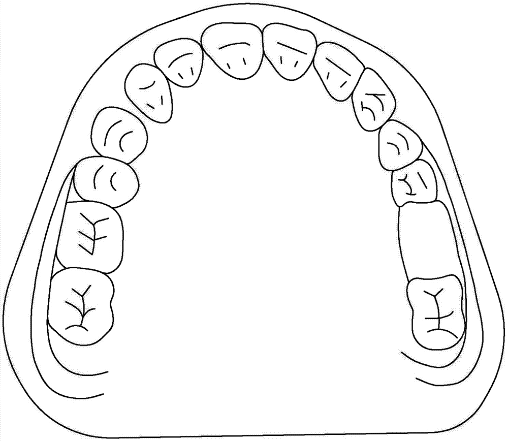 A removable denture and its manufacturing process