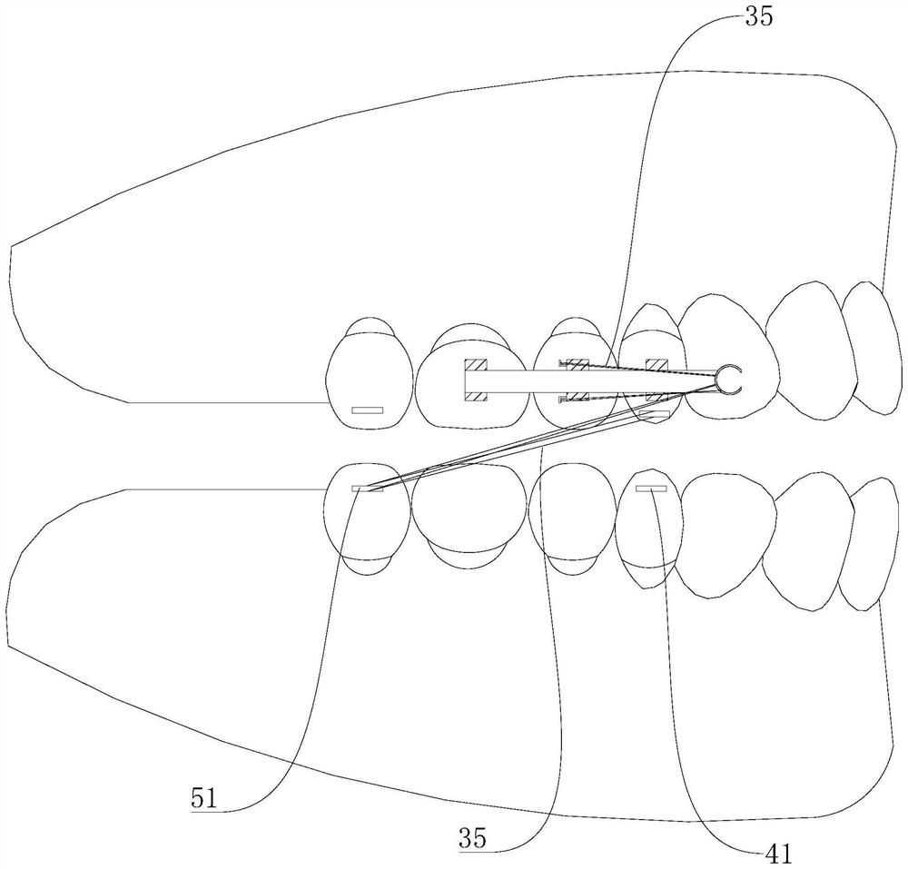 Orthosis for jaw leveling