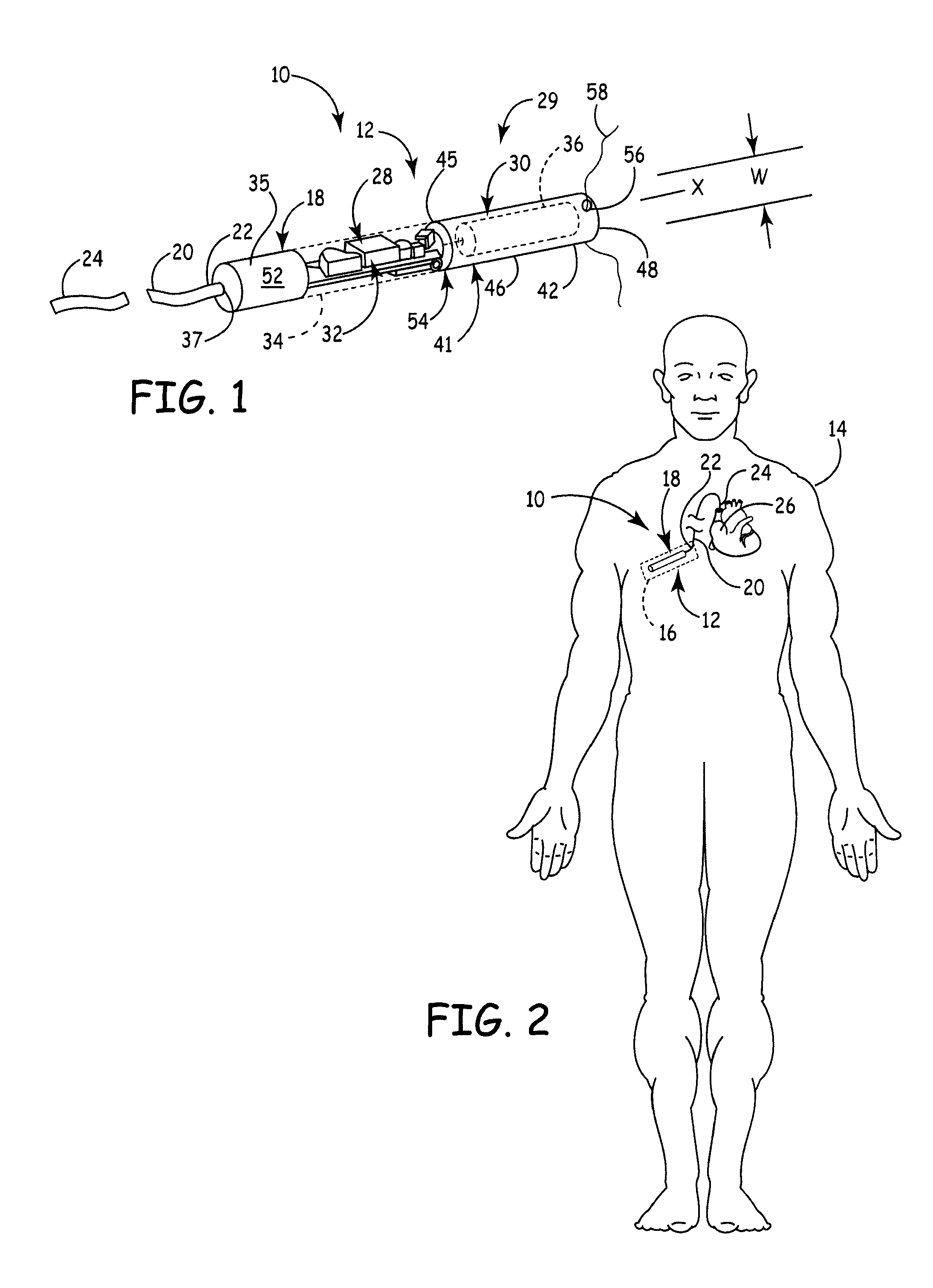 Elongate battery for implantable medical device
