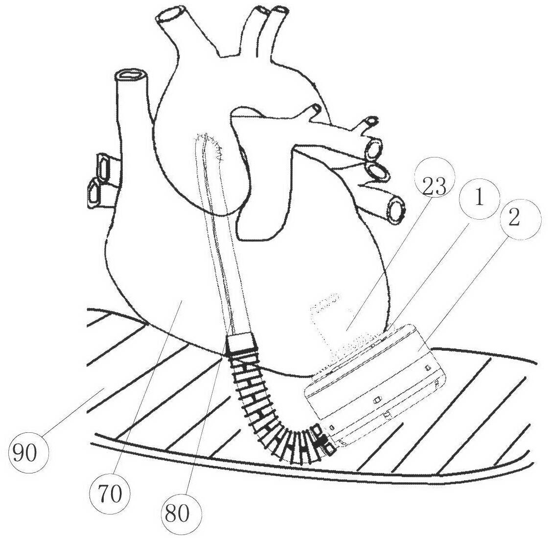 A mechanical device that assists the blood circulation of the heart
