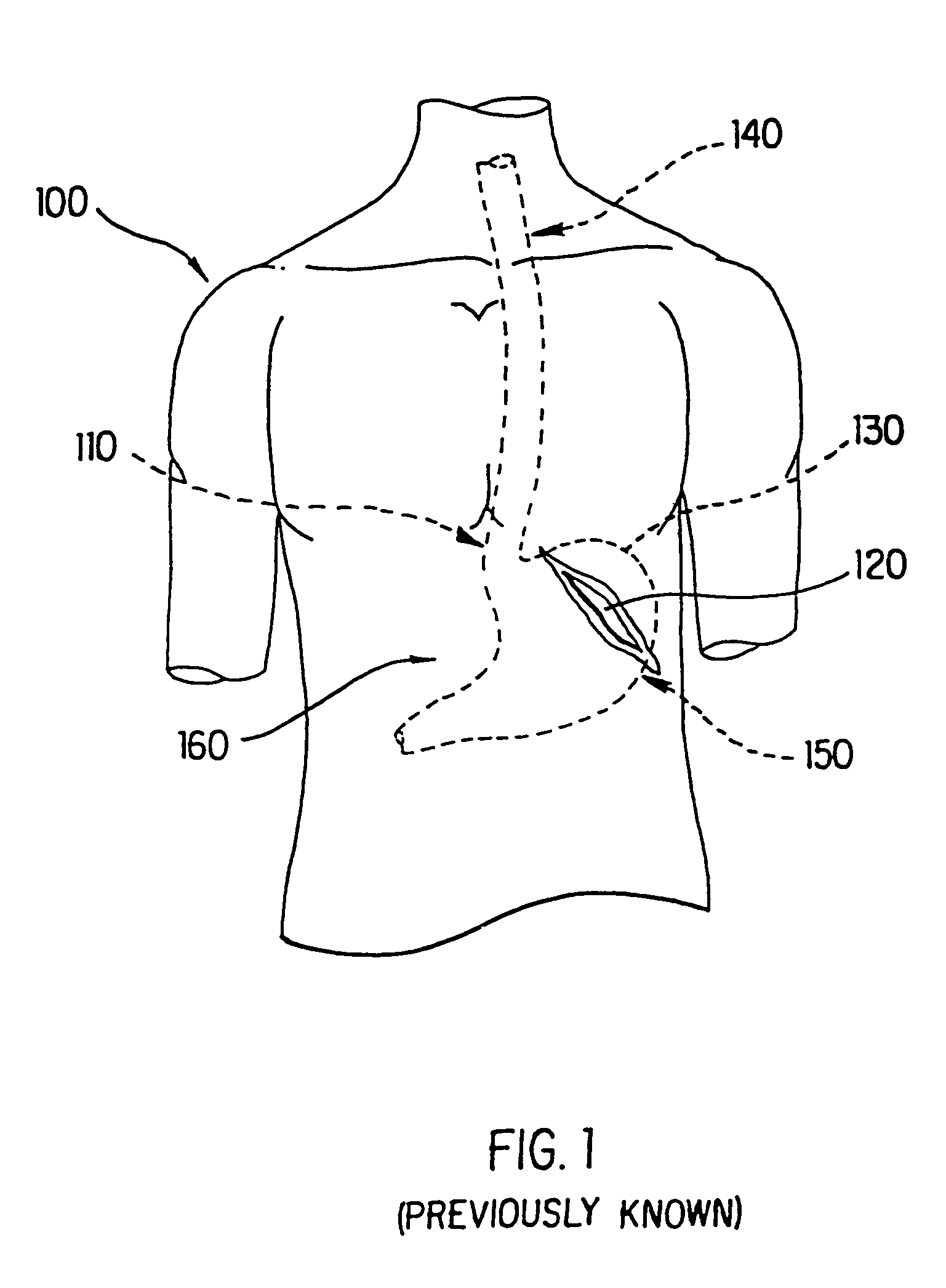 Apparatus for endoscopic repair of the lower esophageal sphincter