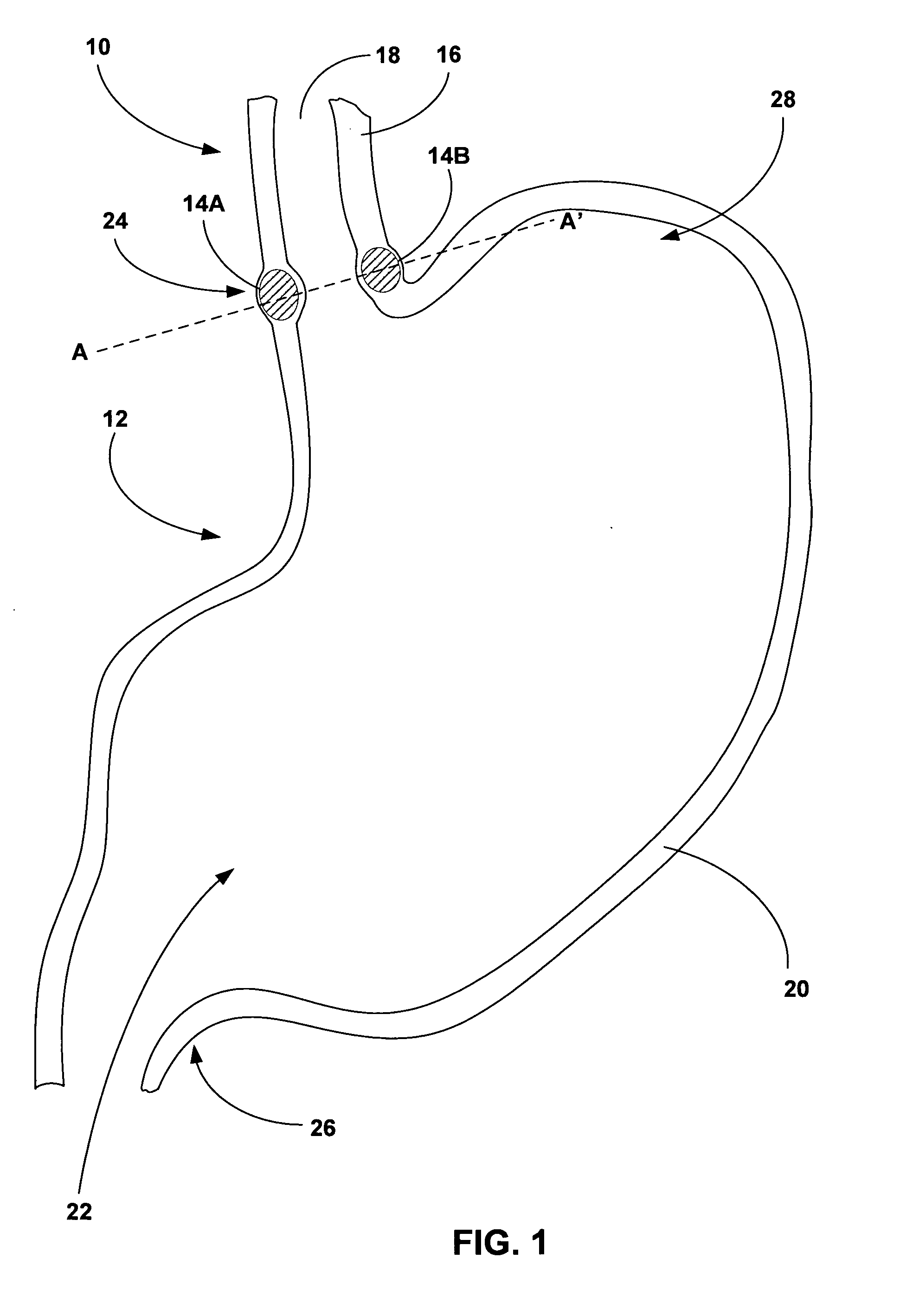 Implantation of tissue bulking devices