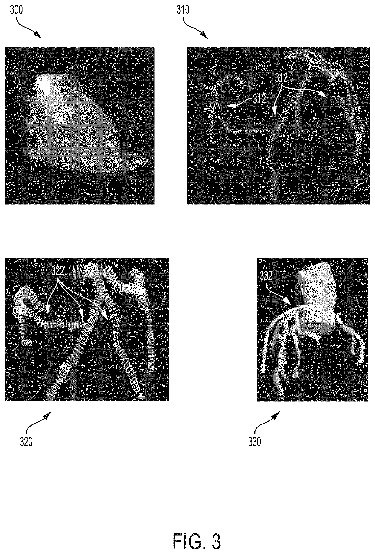 Method and system for non-invasive functional assessment of coronary artery stenosis using flow computations in diseased and hypothetical normal anatomical models
