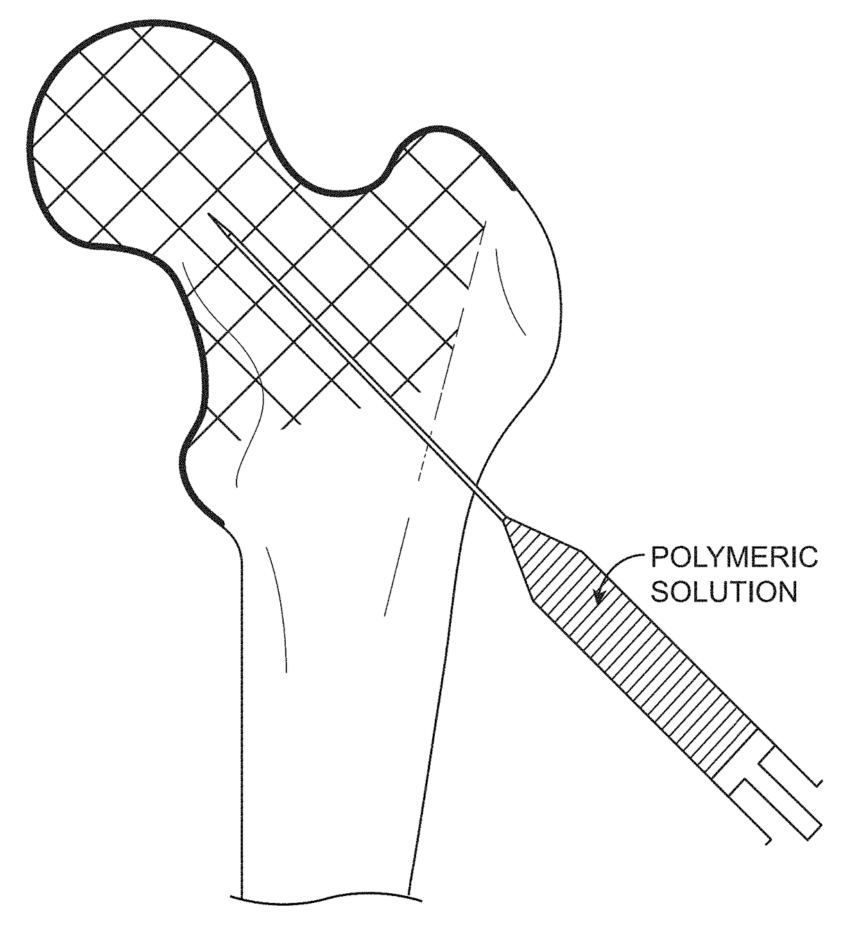 Device, Composition and Method for Prevention of Bone Fracture and Pain