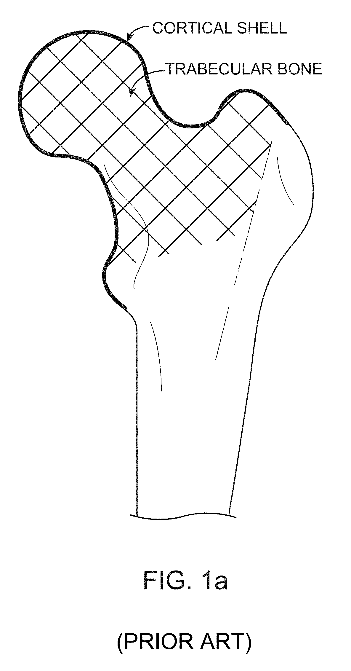 Device, Composition and Method for Prevention of Bone Fracture and Pain