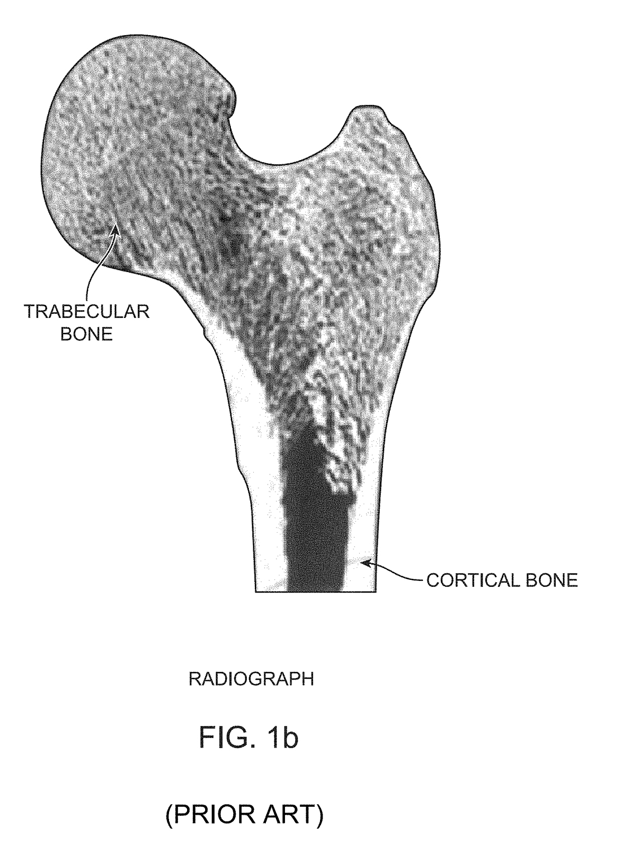 Device, Composition and Method for Prevention of Bone Fracture and Pain