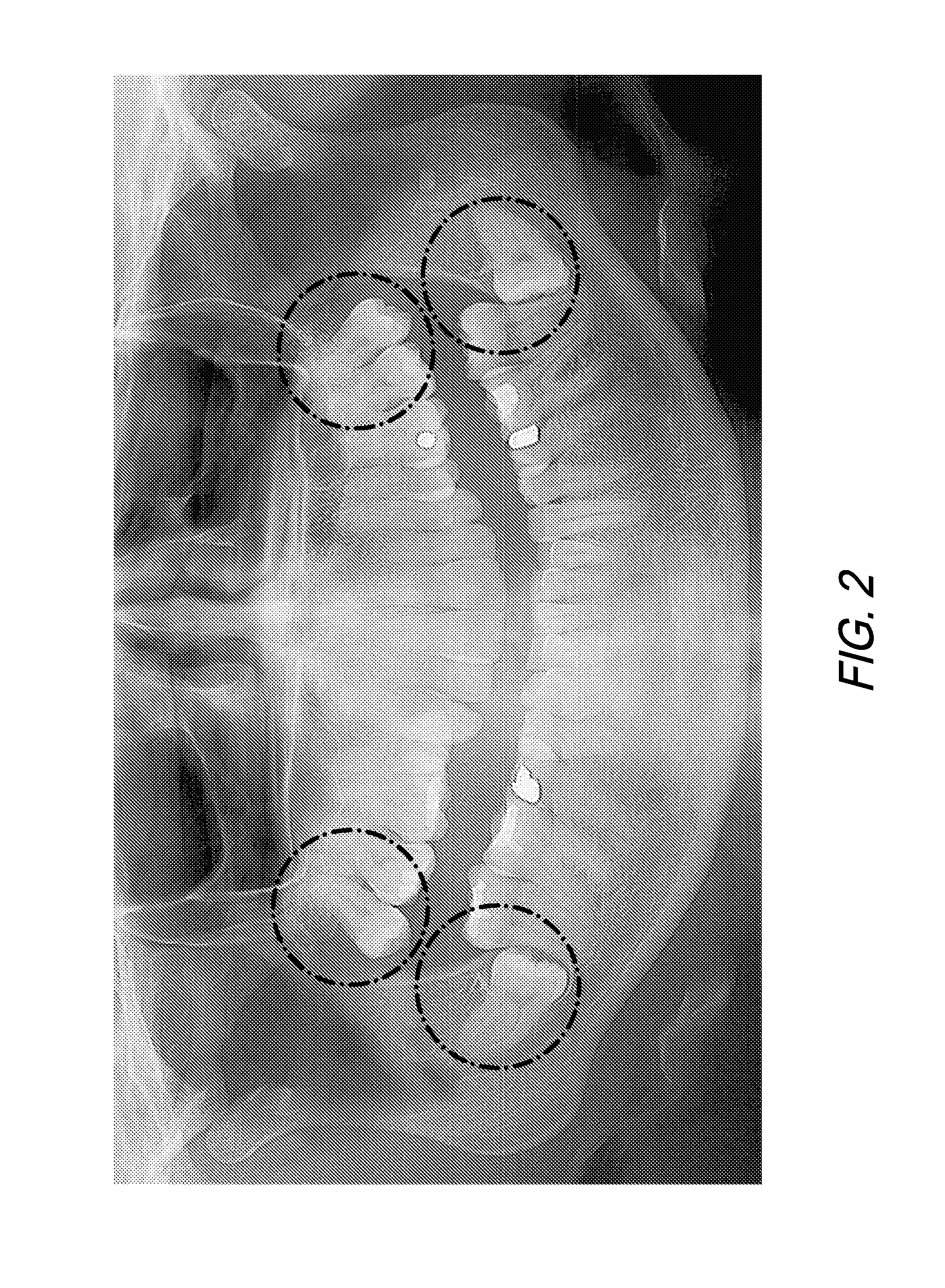 Therapeutic Tooth Bud Ablation