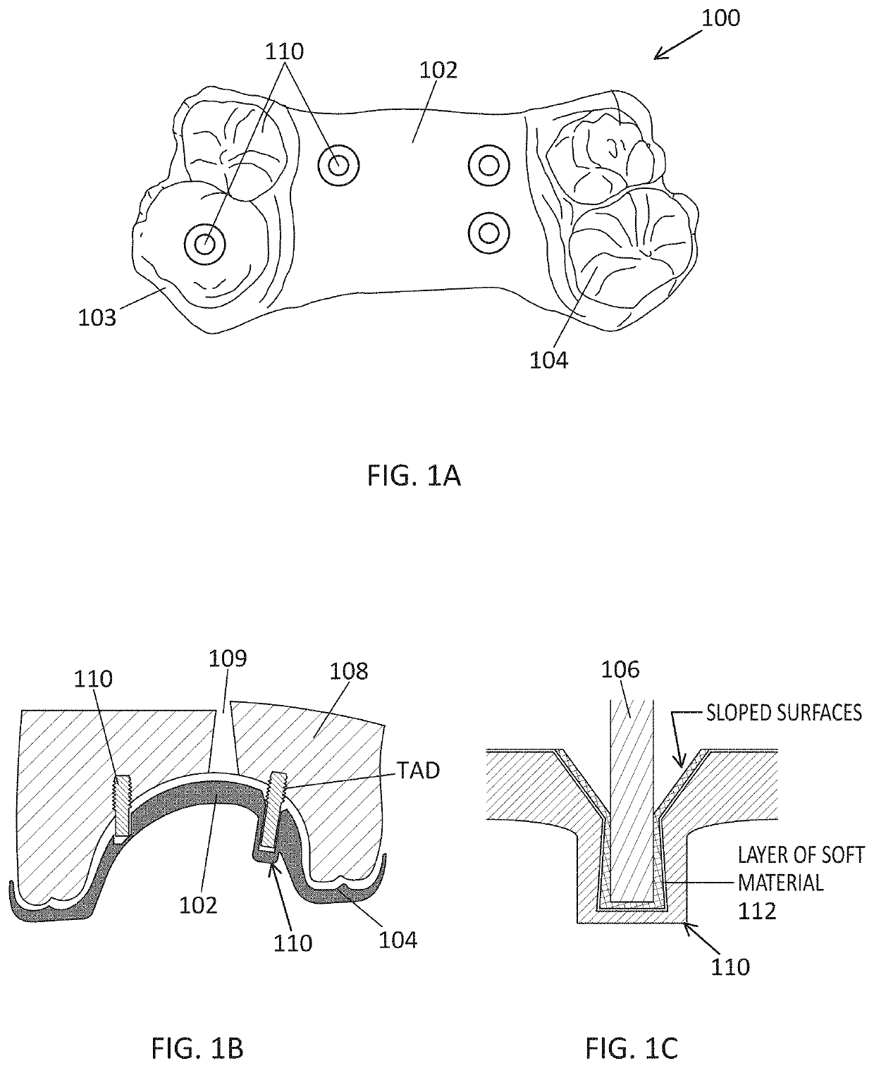 Palatal expander with skeletal anchorage devices