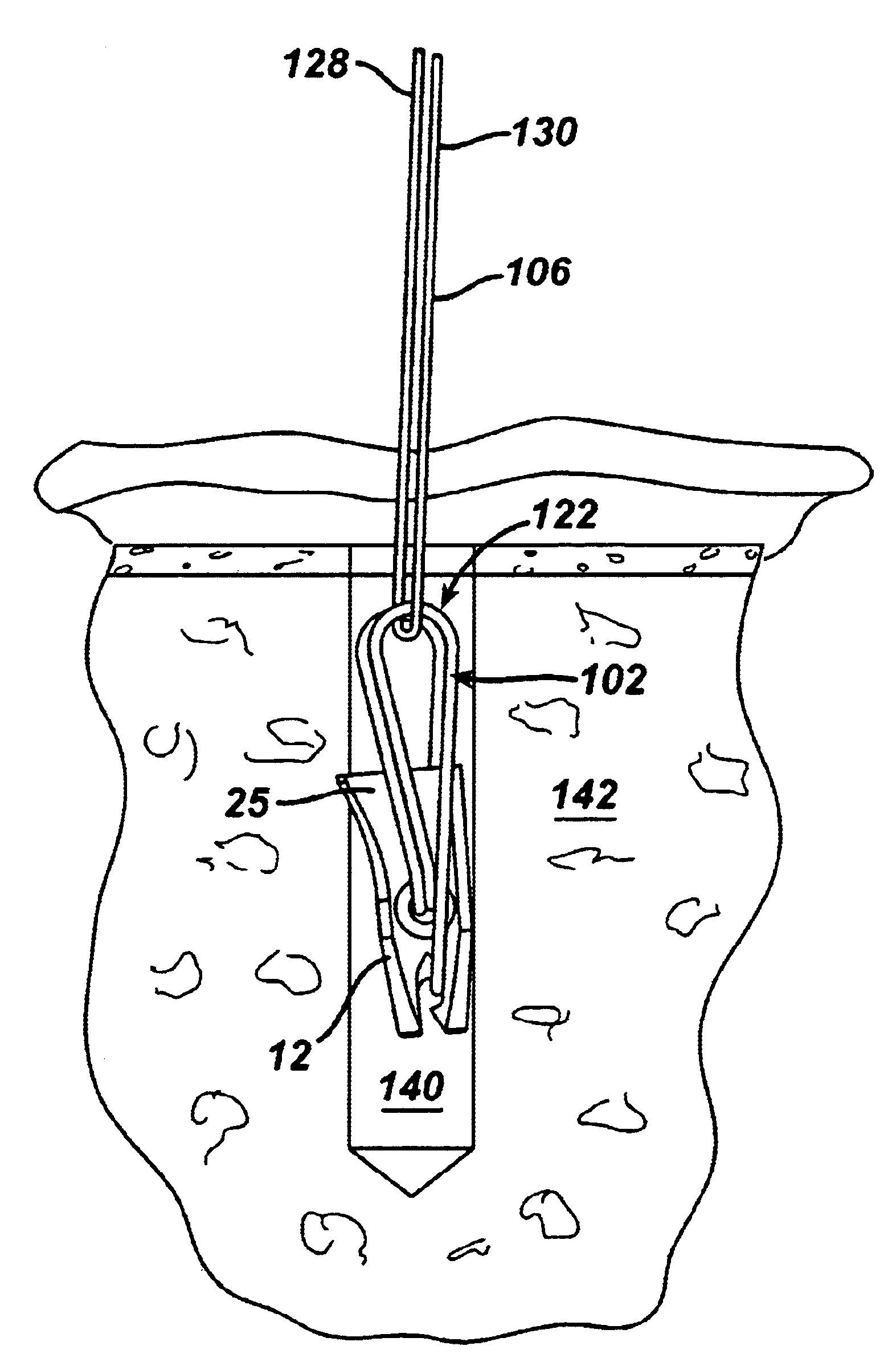 Suture anchor system and method of use