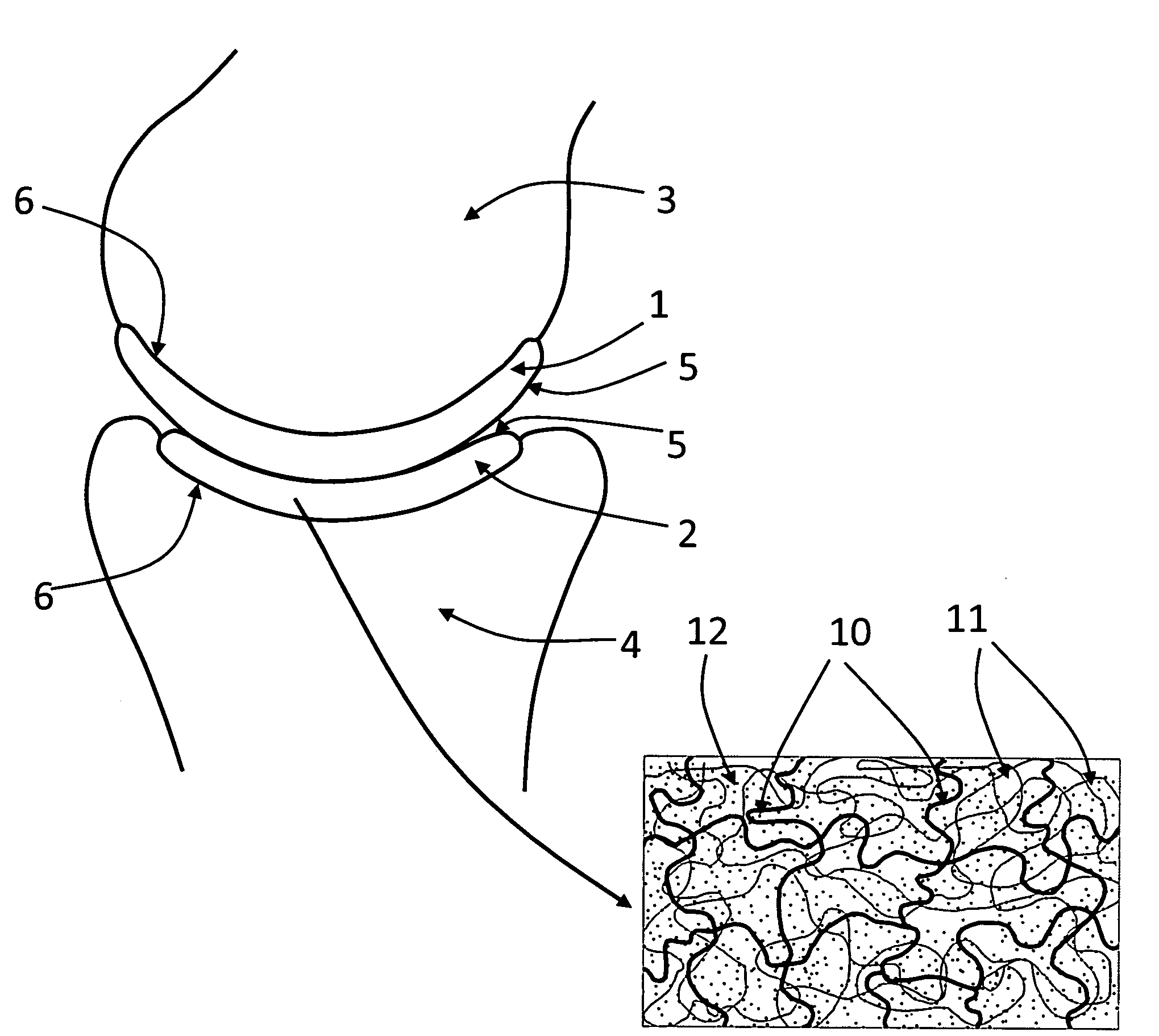 Hydrogel arthroplasty device