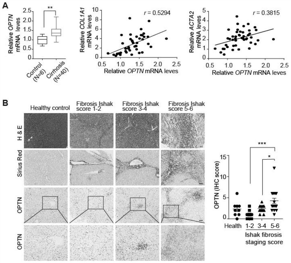 Application of Optineurin in preparation of medicine for diagnosing and treating liver cirrhosis