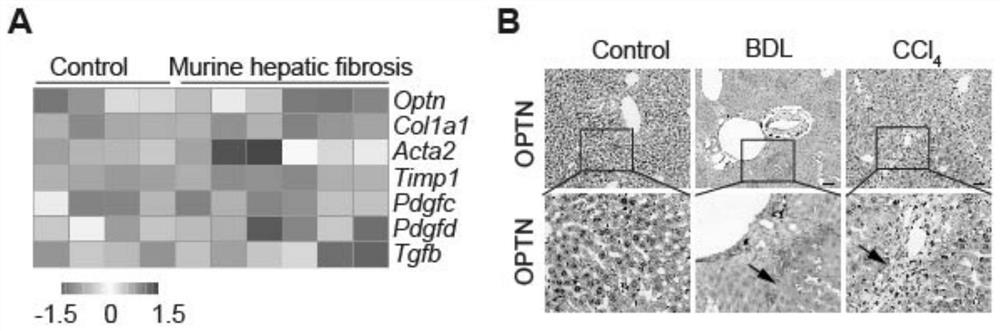 Application of Optineurin in preparation of medicine for diagnosing and treating liver cirrhosis