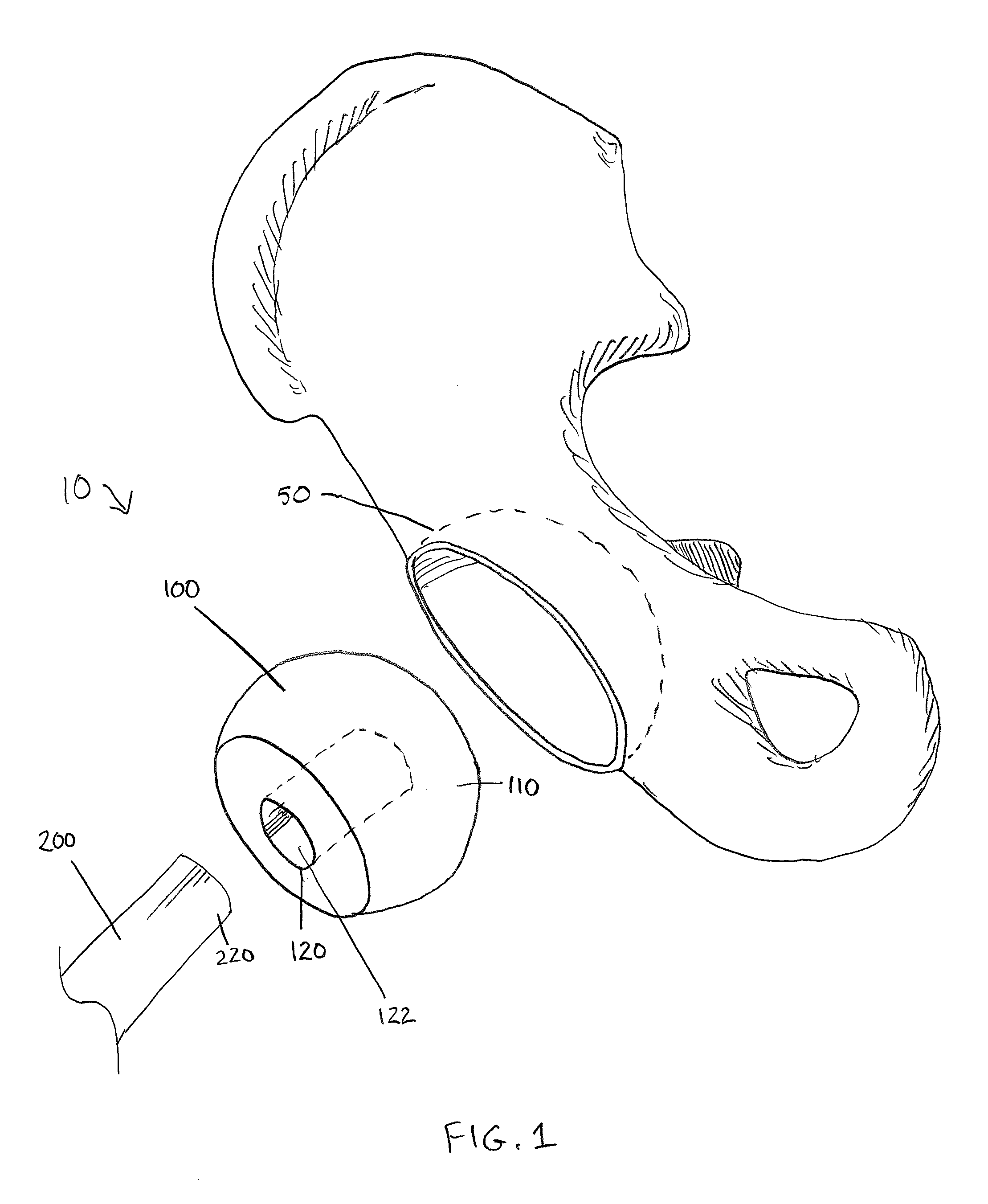 Method and apparatus for attachment in a modular hip replacement or fracture fixation device