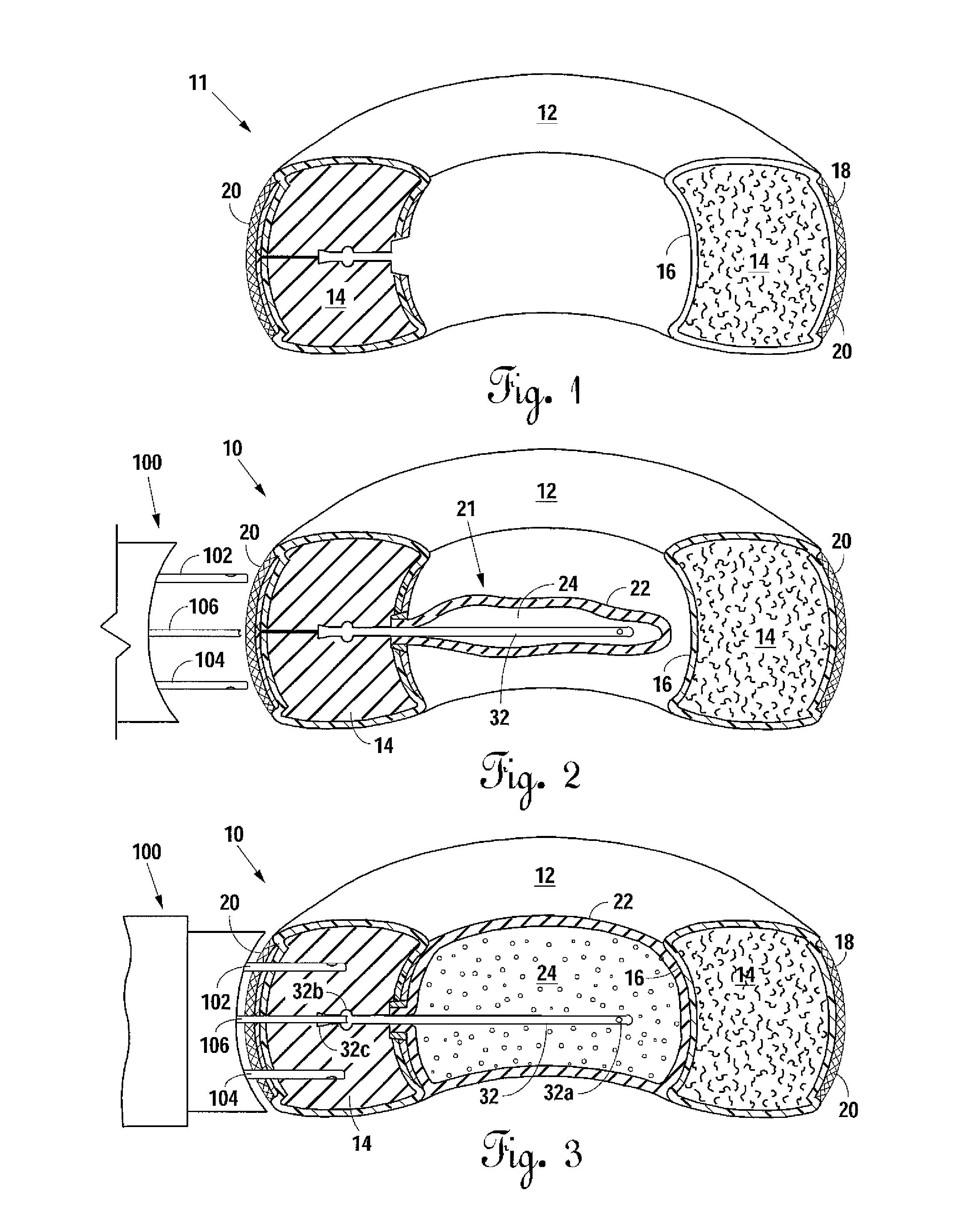 Percutaneous implantable nuclear prosthesis