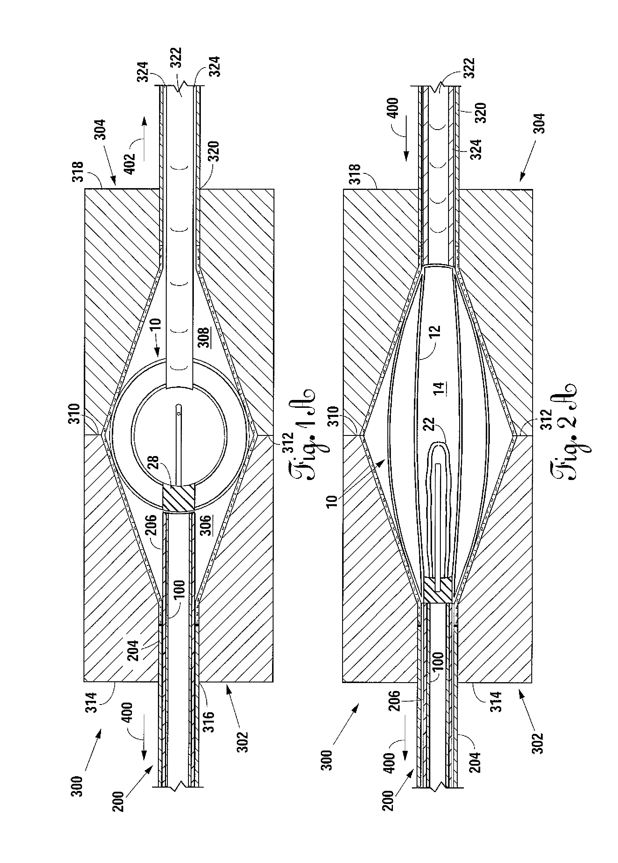 Percutaneous implantable nuclear prosthesis