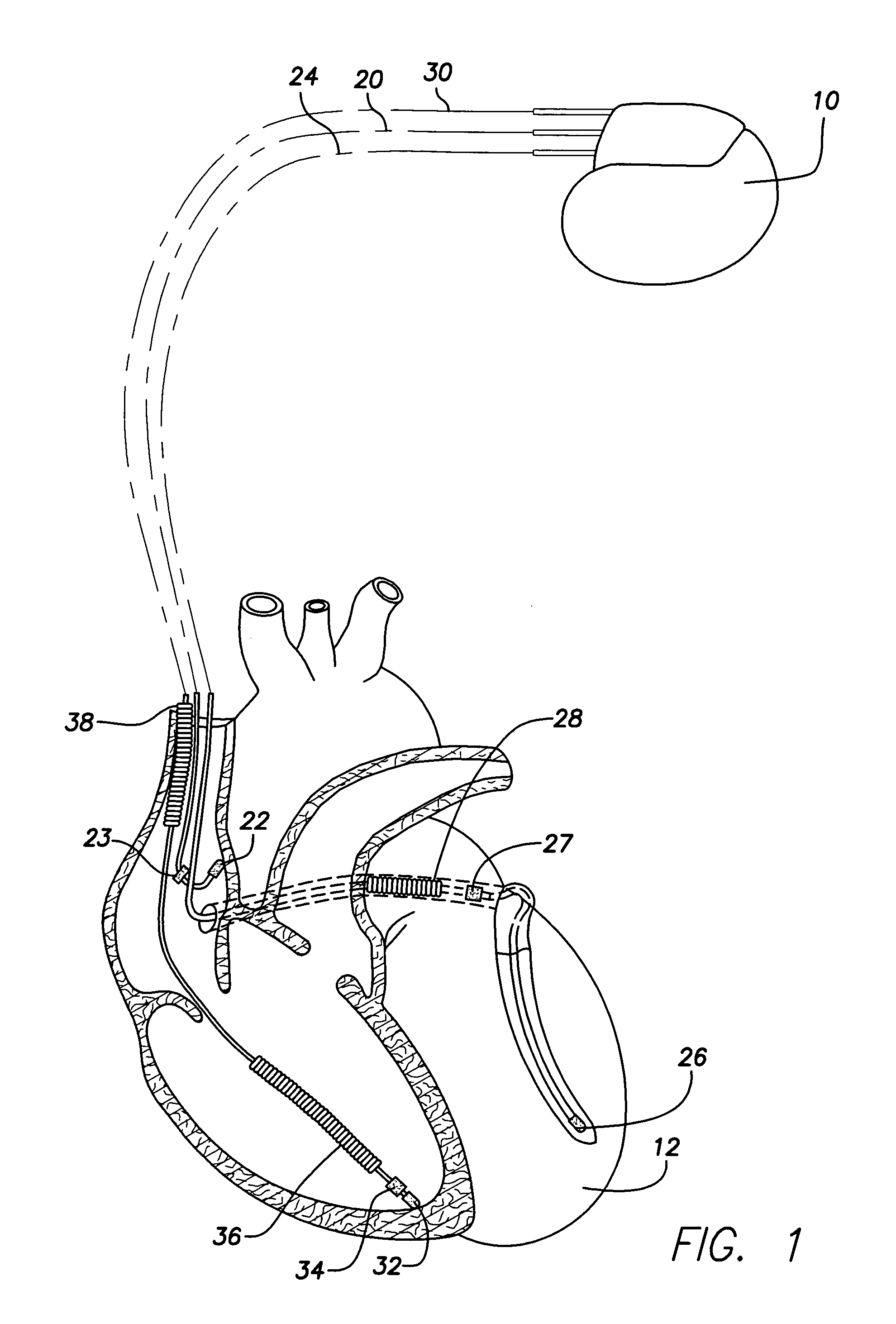System and method for providing improved specificity for automatic mode switching within an implantable medical device