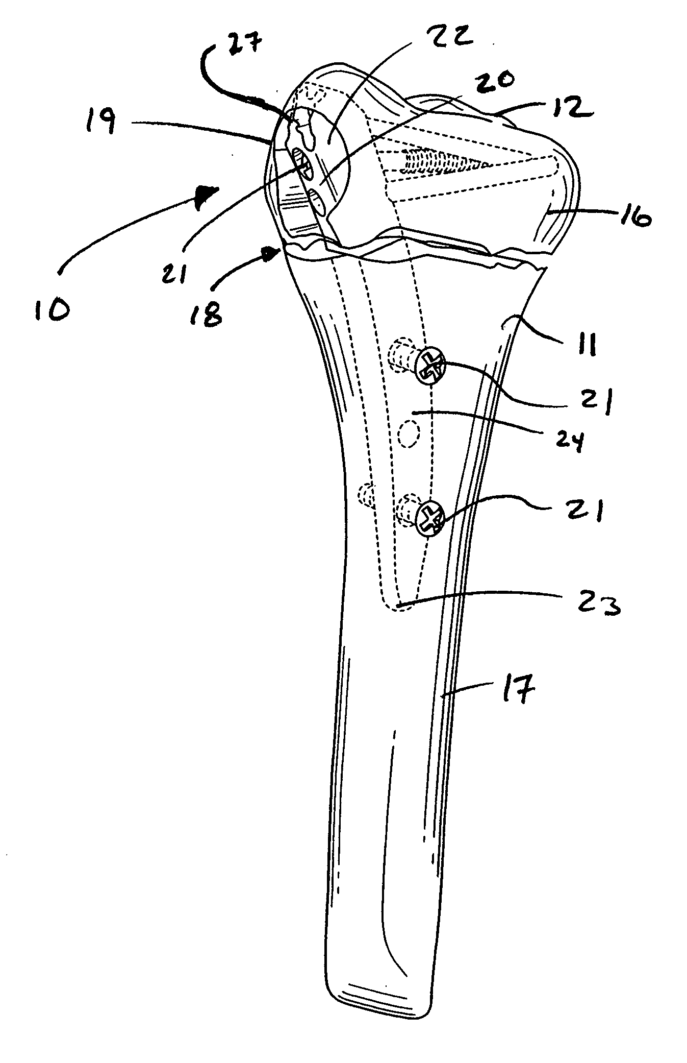 Intramedullary fixation assembly and devices and methods for installing the same