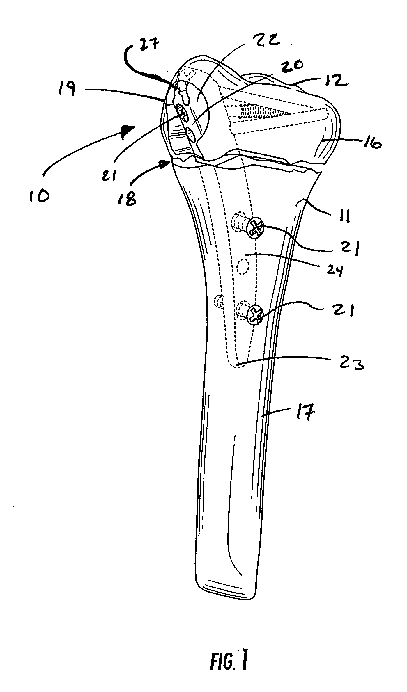 Intramedullary fixation assembly and devices and methods for installing the same