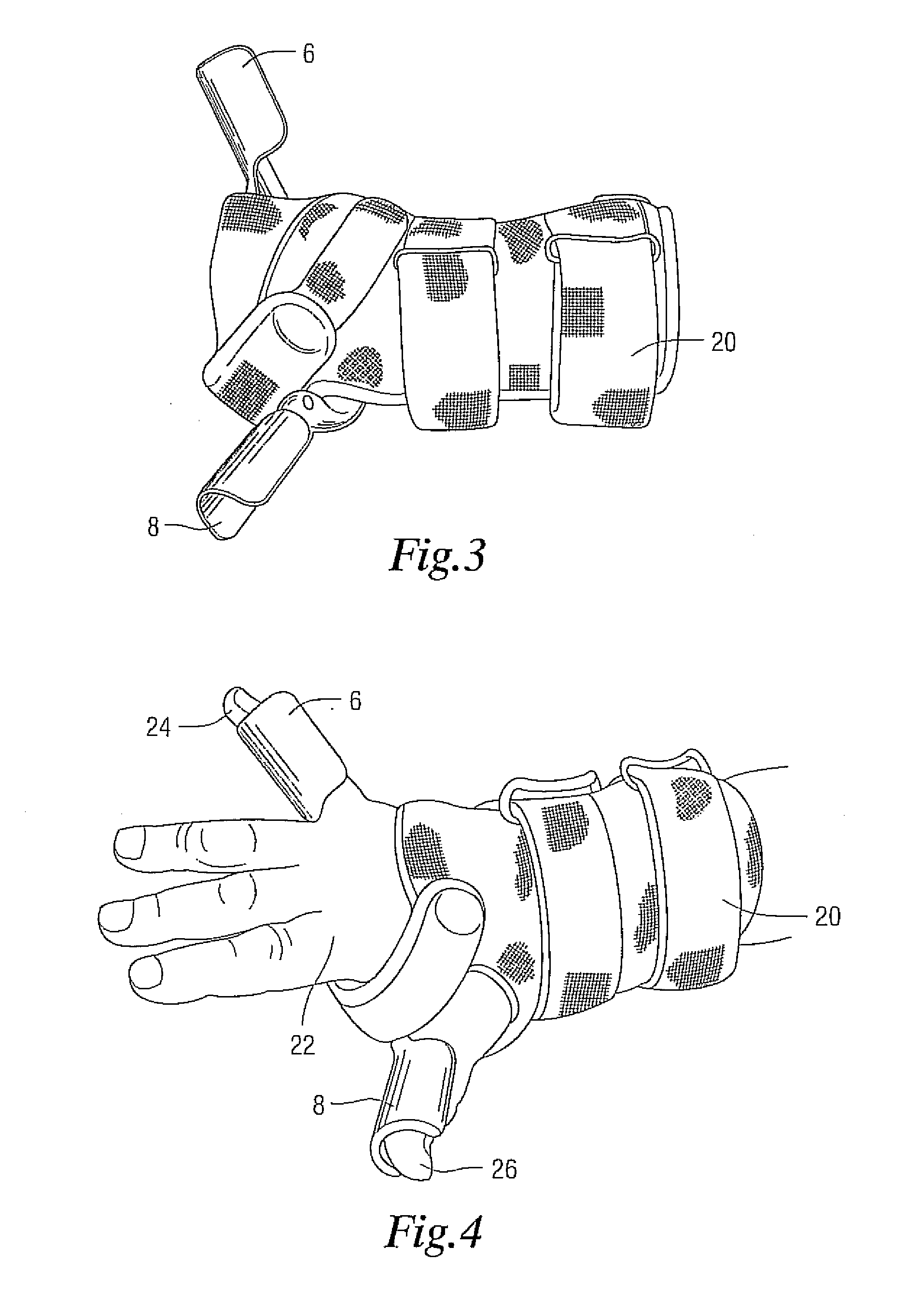 Method and Apparatus for Treating Carpal Tunnel Syndrome