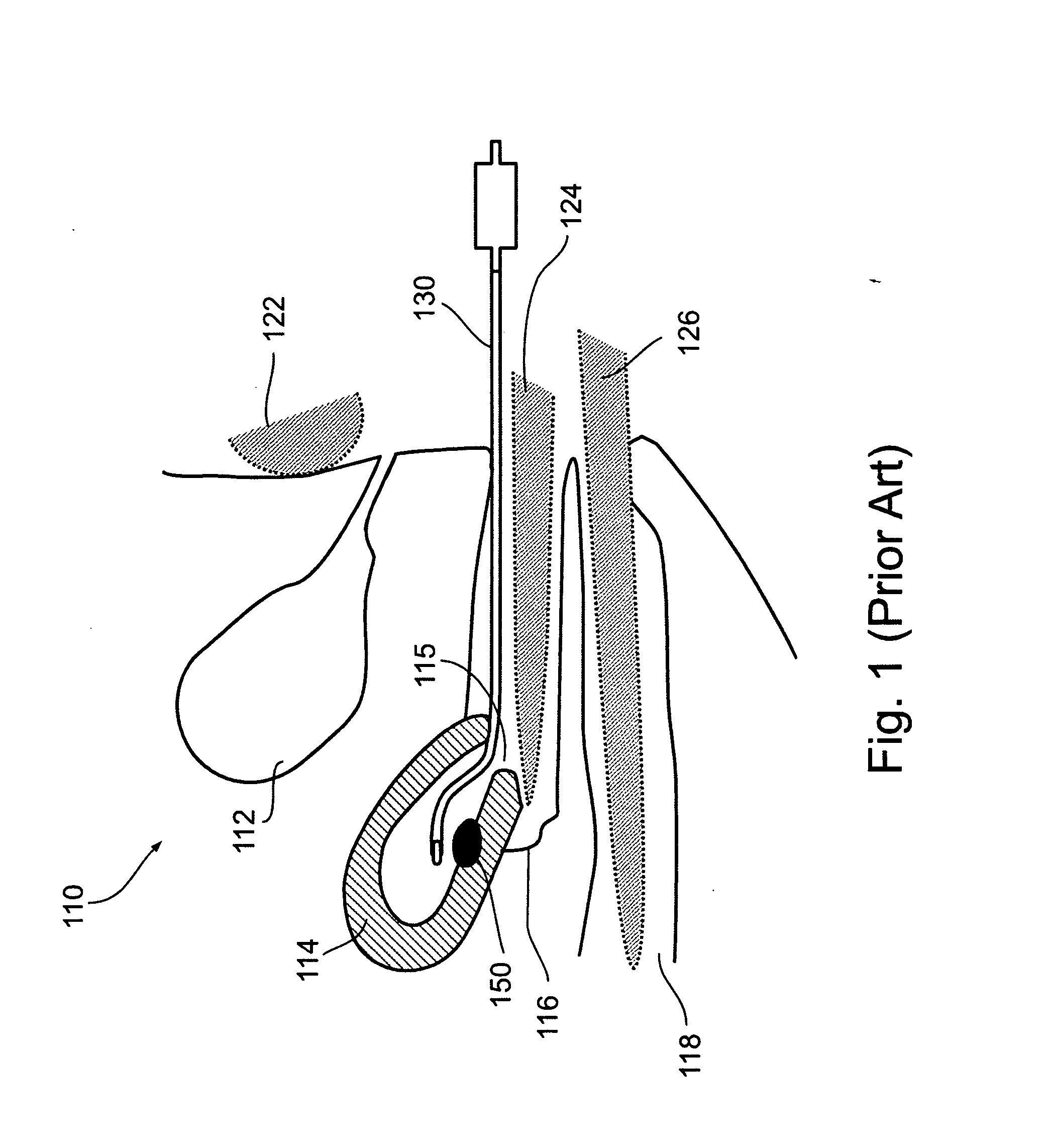 Apparatus and method for thermal ablation of uterine fibroids