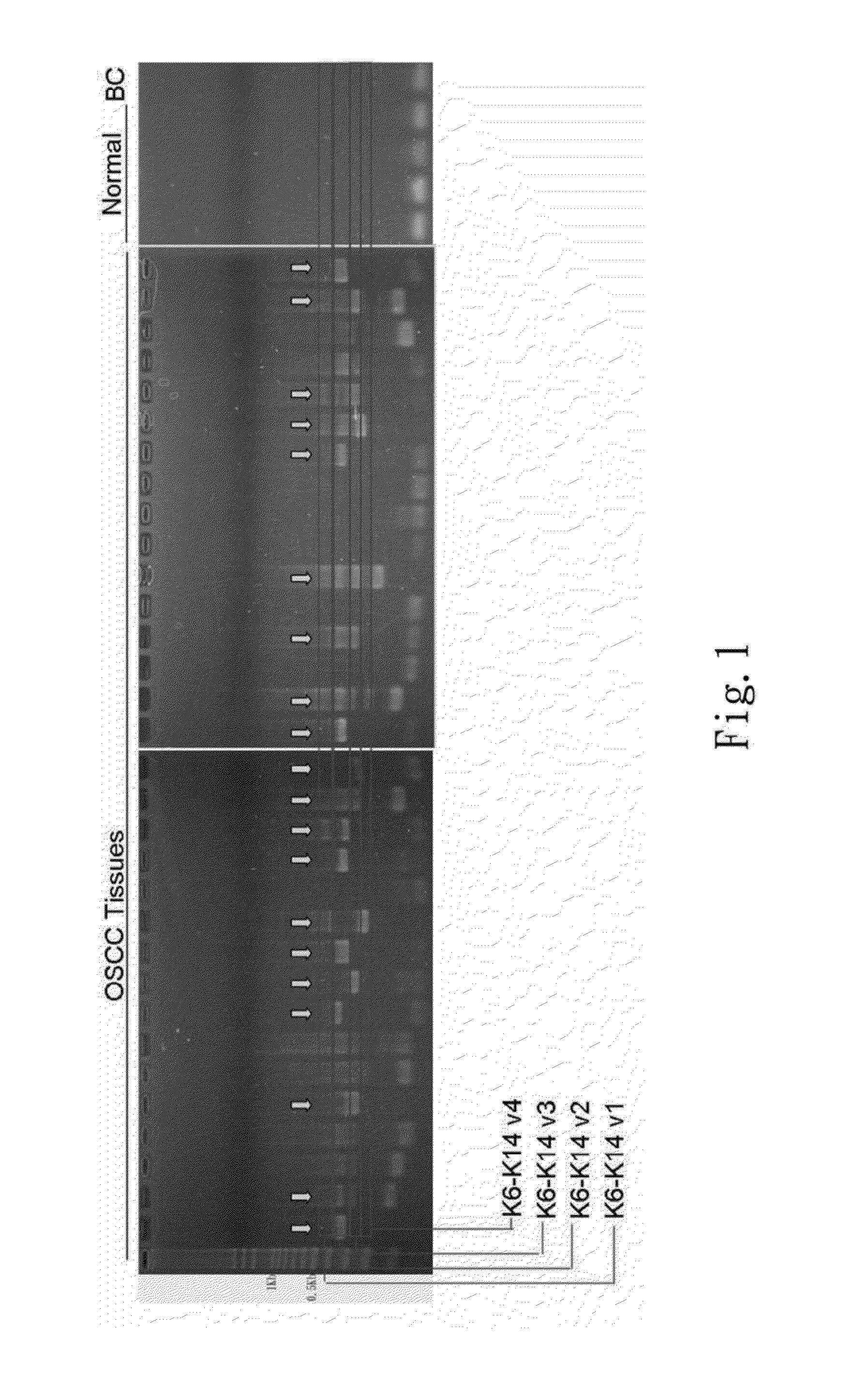 Method for in vitro detecting keratin gene fusion of squamous-cell cancer