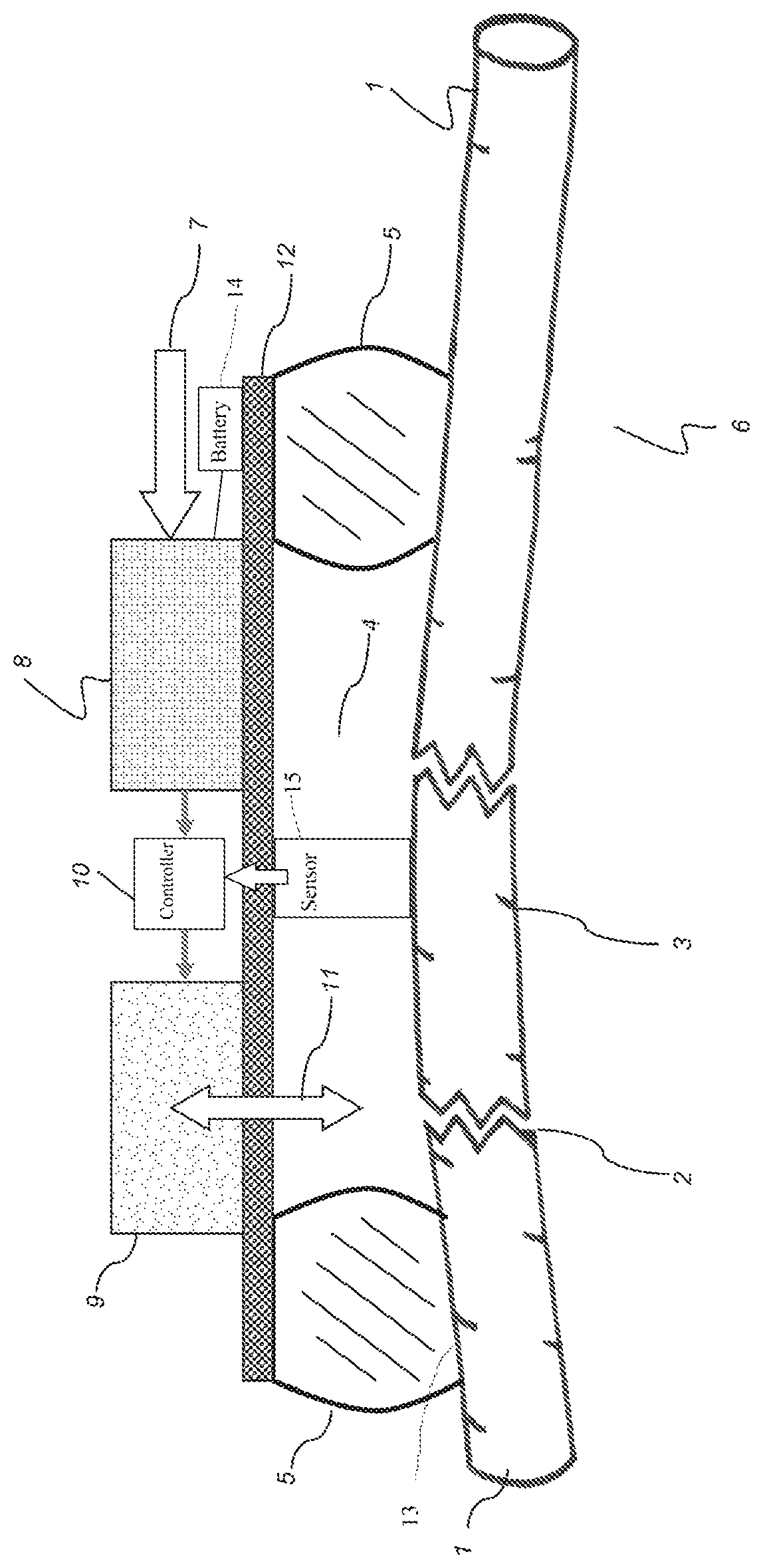System for dynamically stabilizing the chest wall after injury, fracture, or operative procedures