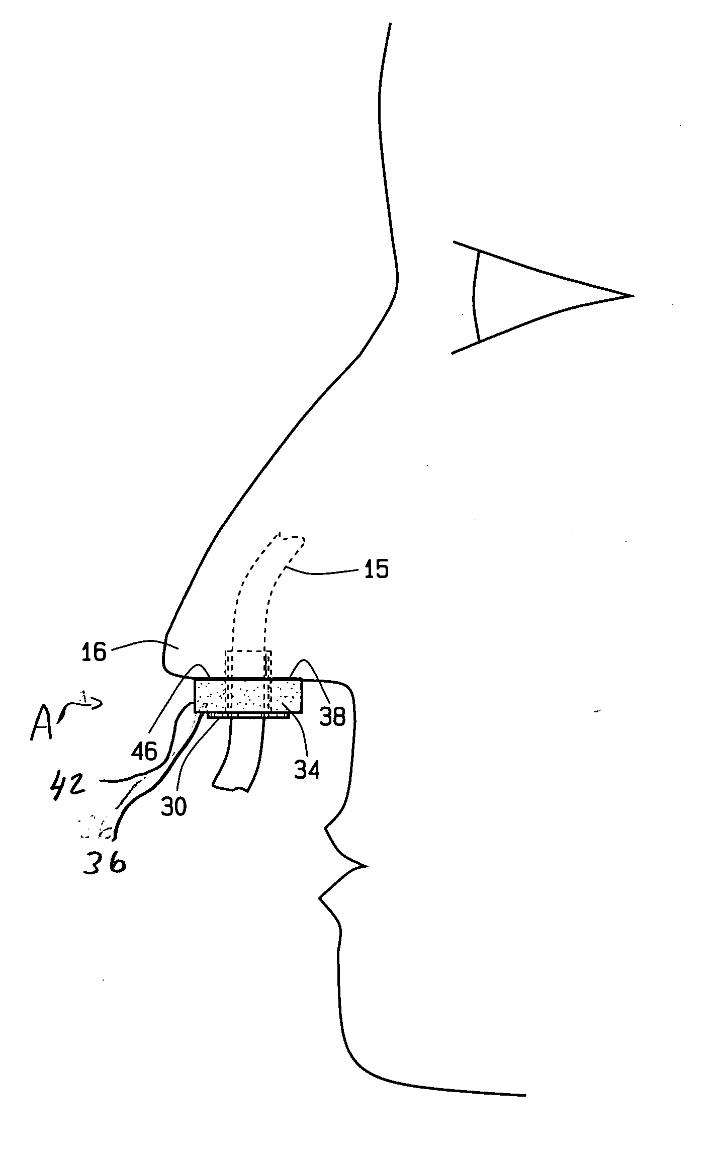 Nasal assembly and method of positioning nasogastric tubing