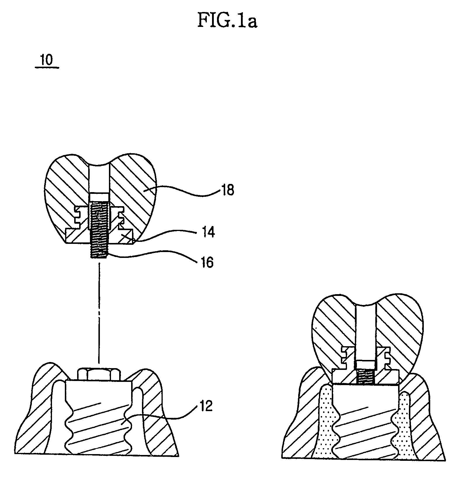 Method for treating a screw-cement retained prosthesis and adjustment for a screw-cement retained prosthesis