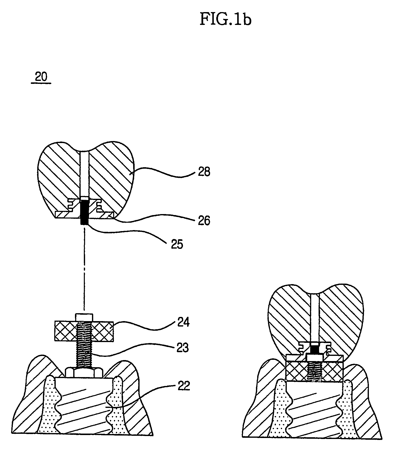 Method for treating a screw-cement retained prosthesis and adjustment for a screw-cement retained prosthesis