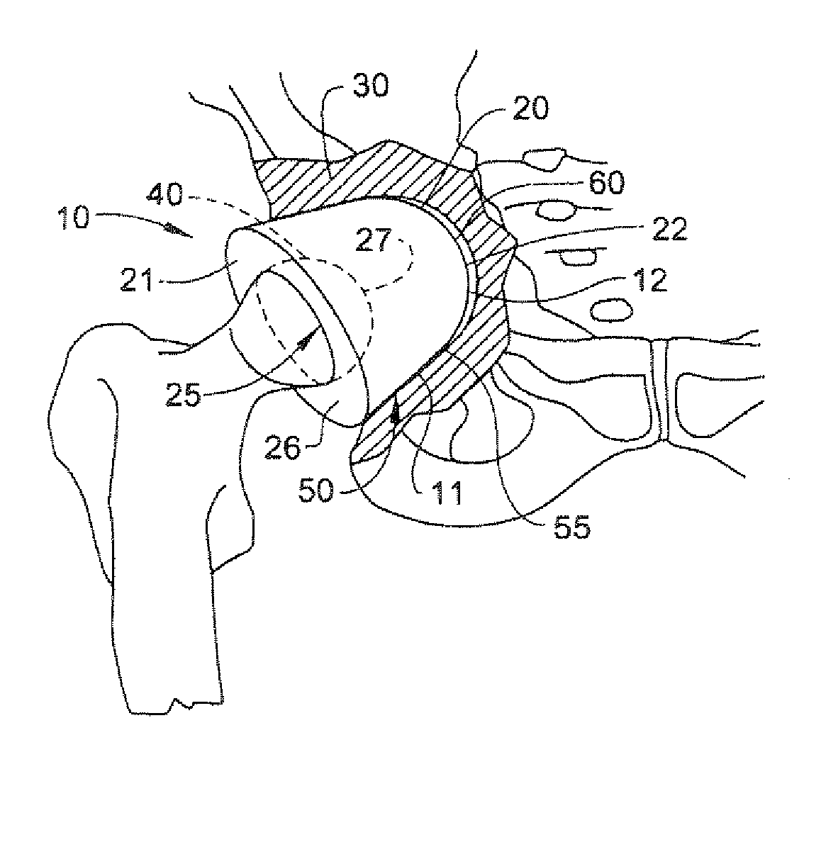 Acetabular component of total hip replacement assembly
