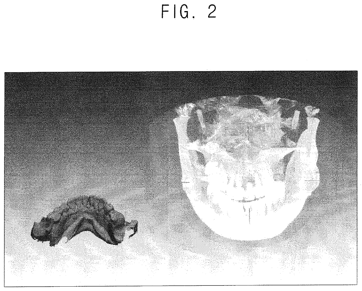 Automated method for aligning 3D dental data and computer readable medium having program for performing the method