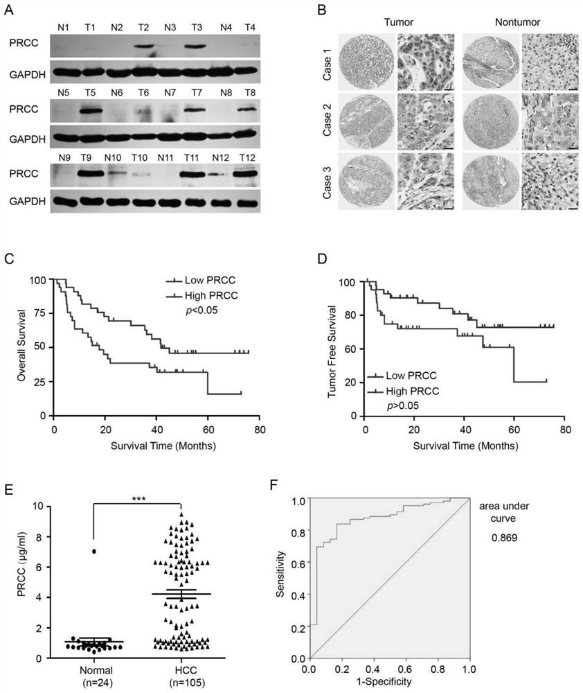 Application of PRCC or up-regulation agent thereof in liver cancer treatment and application of PRCC in liver cancer diagnosis or prognosis