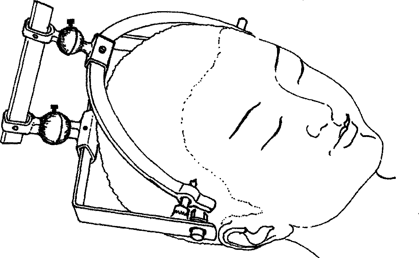 Intracranial hematoma directional skull drilling instrument