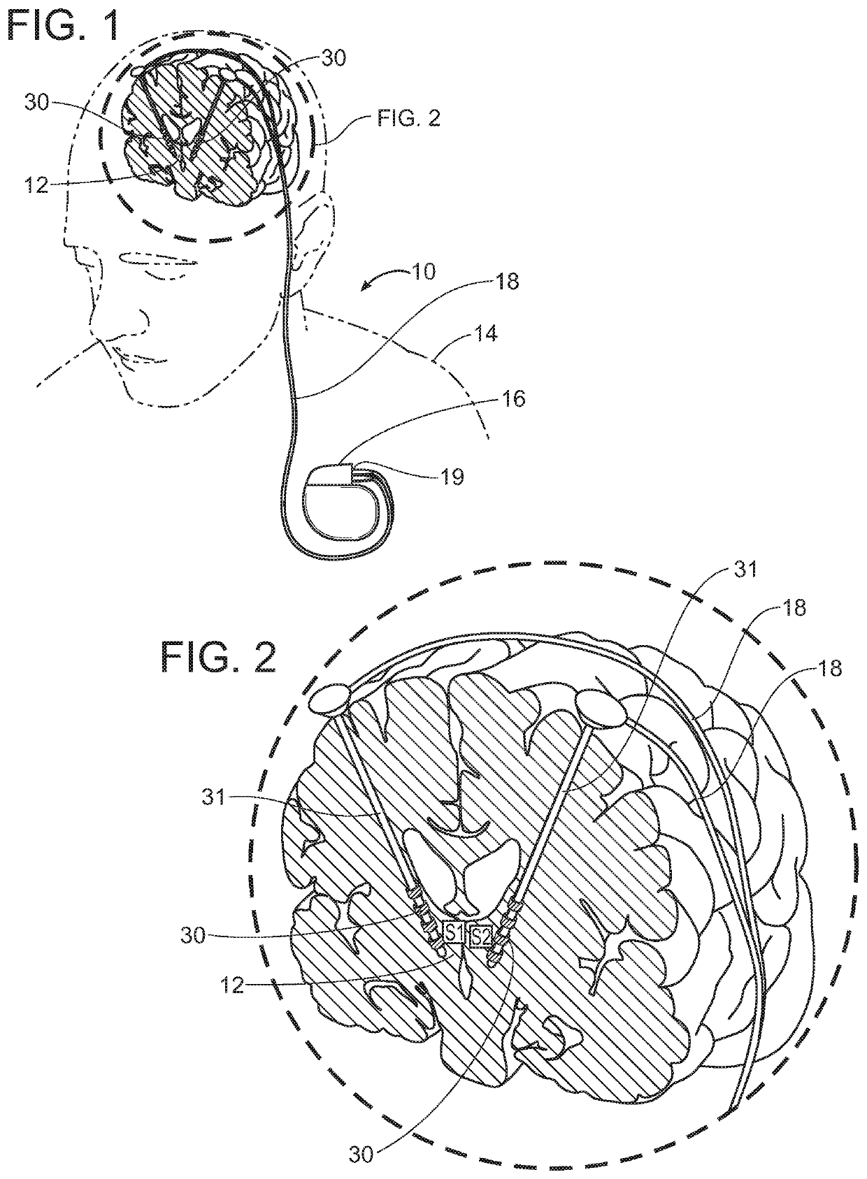 Neuromodulation system and method with feedback optimized electrical field generation
