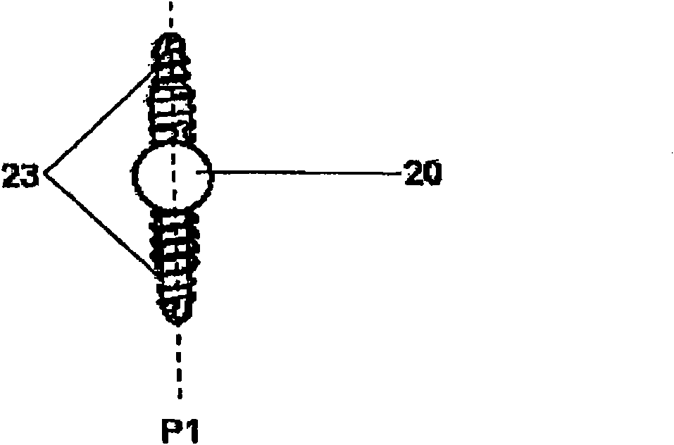 Nail system and method for an olecranon osteotomy