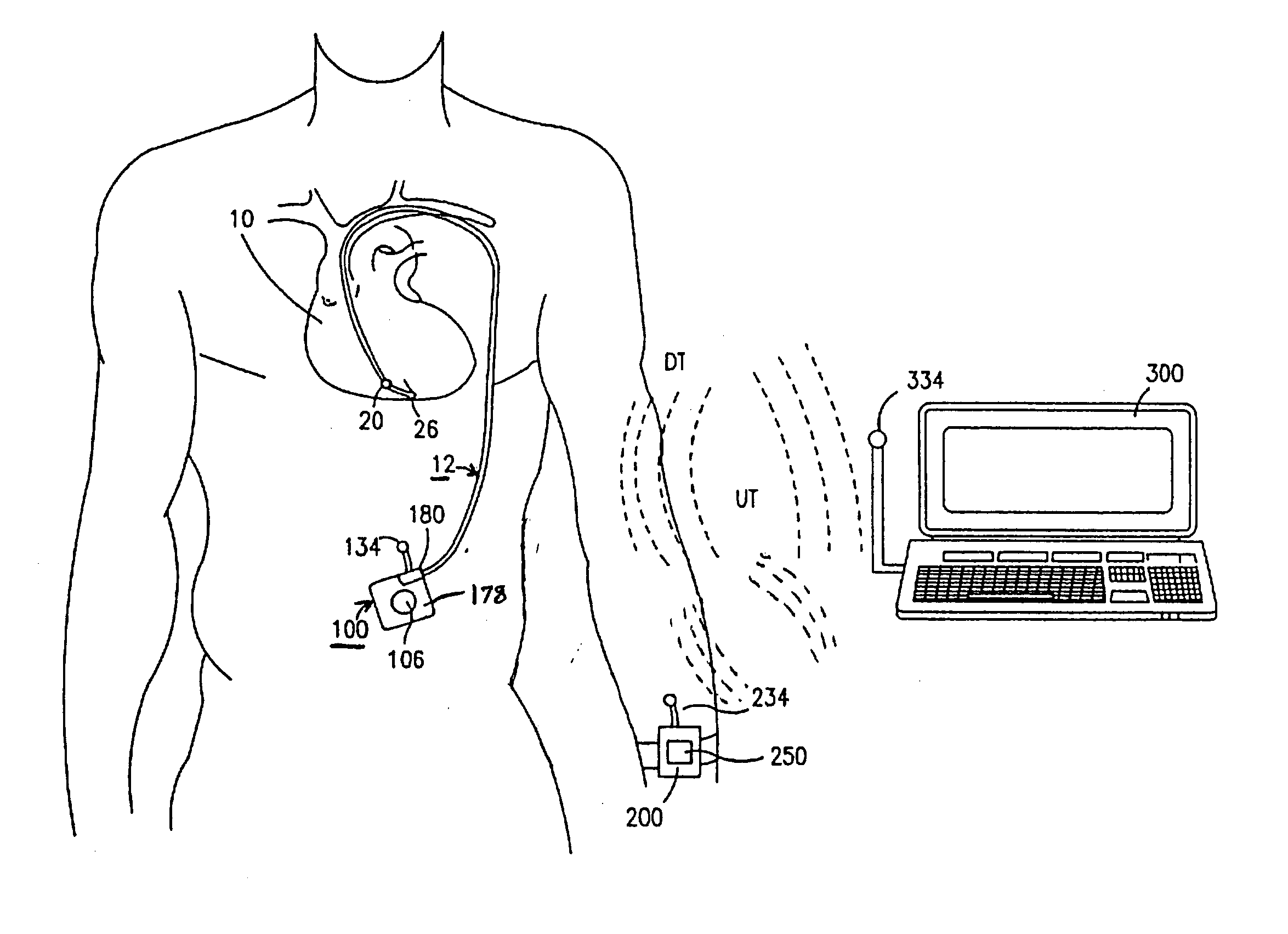 Methods and apparatus for estimation of ventricular afterload based on ventricular pressure measurements