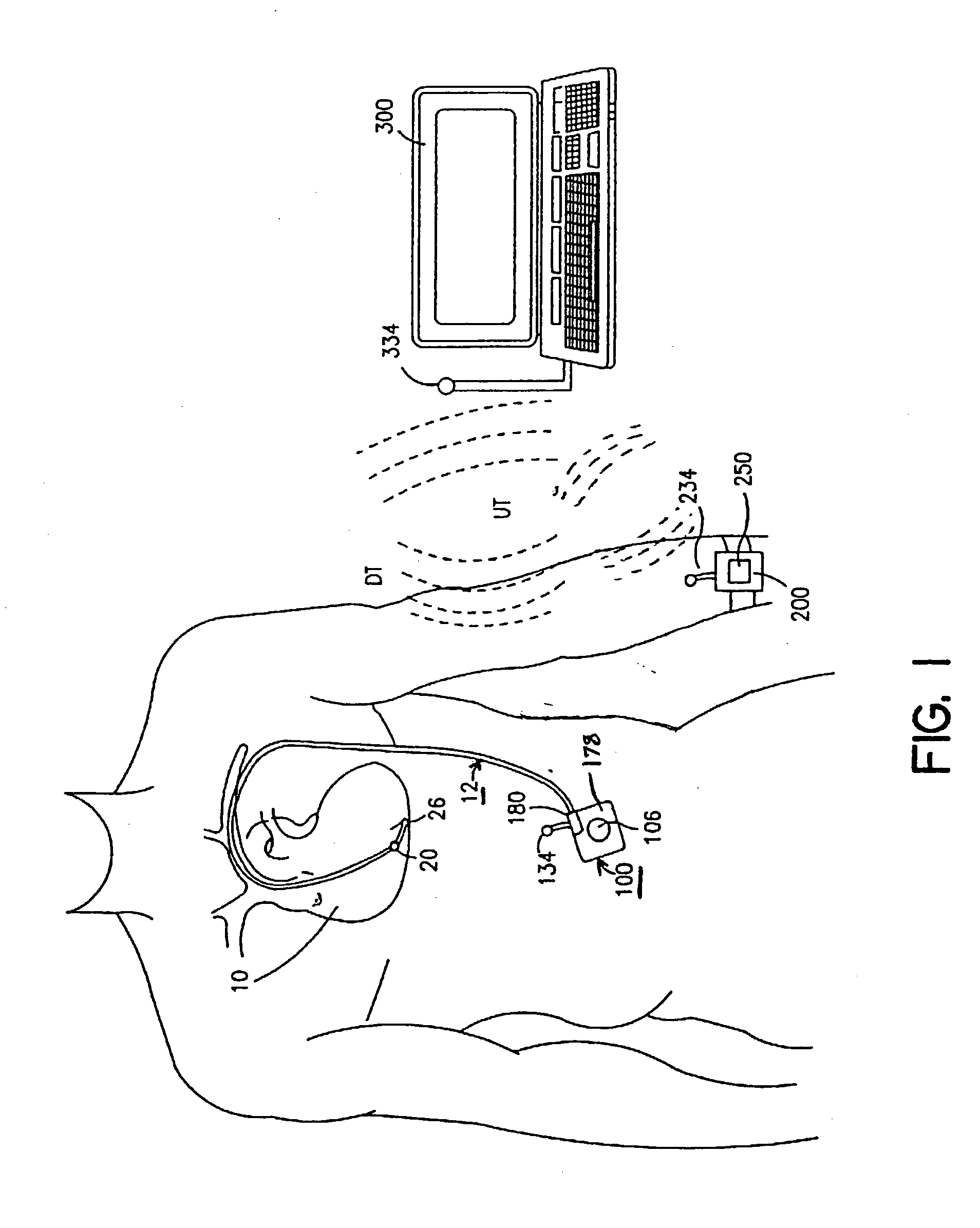 Methods and apparatus for estimation of ventricular afterload based on ventricular pressure measurements