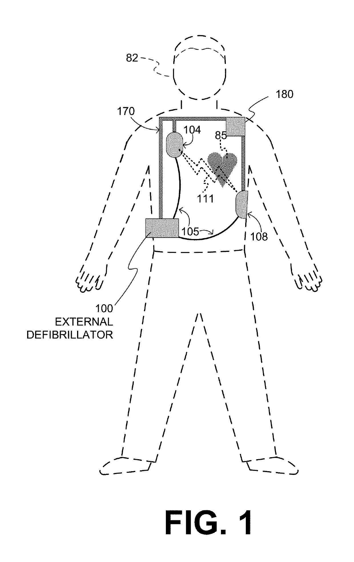 Wearable cardioverter defibrillator with improved ECG electrodes