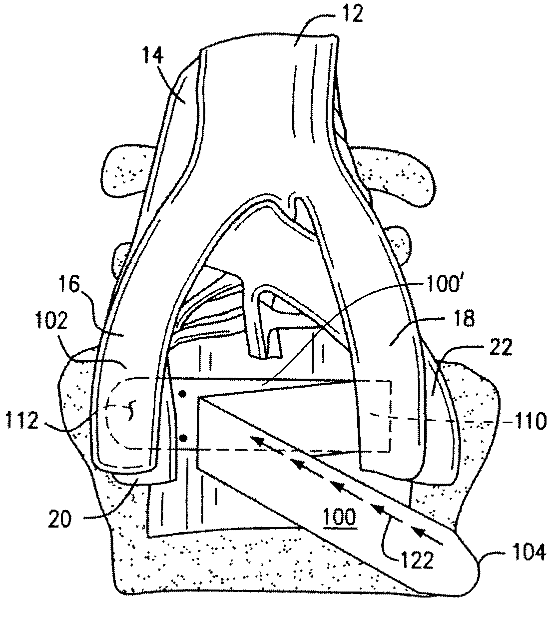 Methods and apparatus for vascular protection in spinal surgery