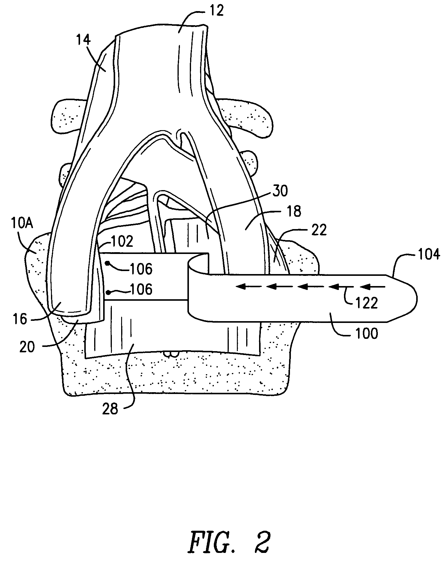 Methods and apparatus for vascular protection in spinal surgery