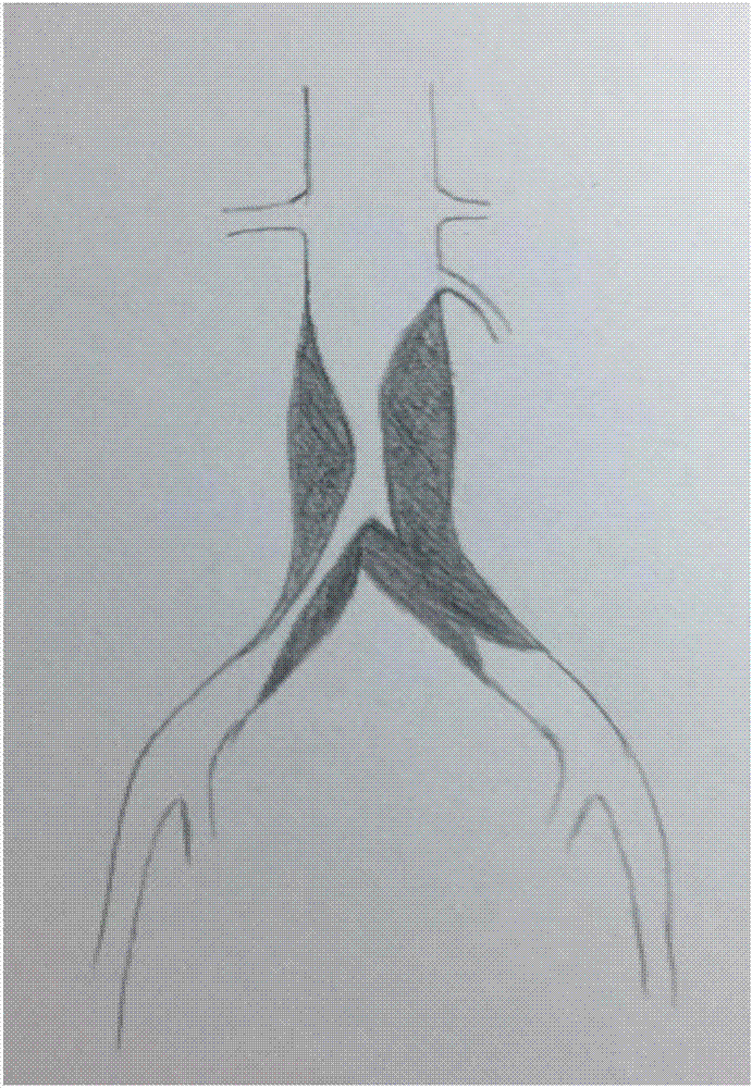 Integrated stent for aortoiliac artery