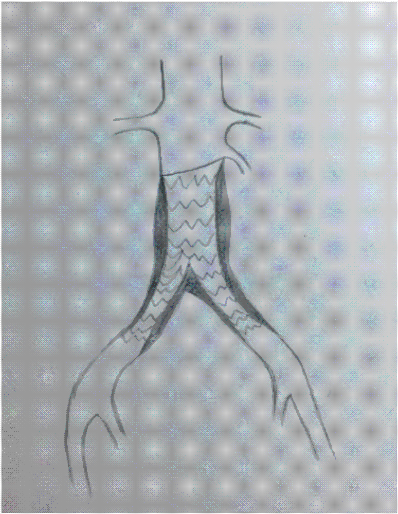 Integrated stent for aortoiliac artery