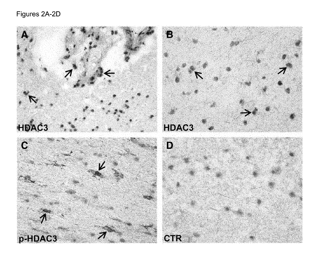 Biomarkers for predicting relapse in multiple sclerosis