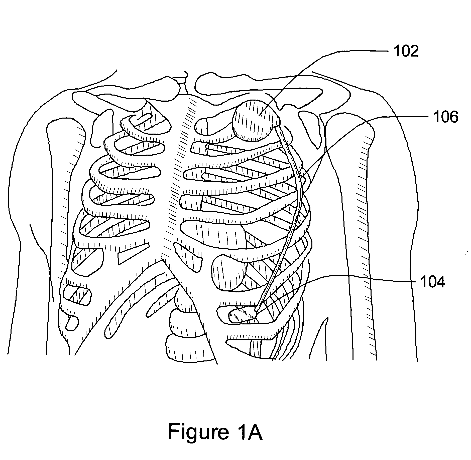 Subcutaneous cardiac stimulation system with patient activity sensing